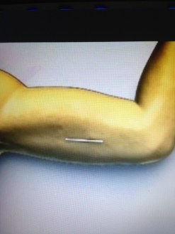 IMG_0662.JPG implanon