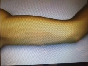 IMG_0671.JPG implanon-2