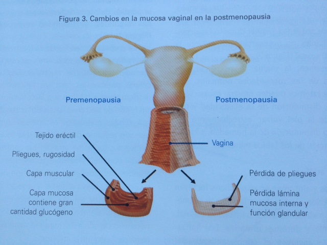 ATROFIA VULVOVAGINAL