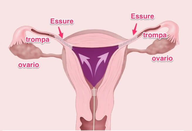 essure3