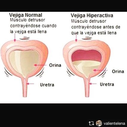 VEJIGA HIPERACTIVA-6g
