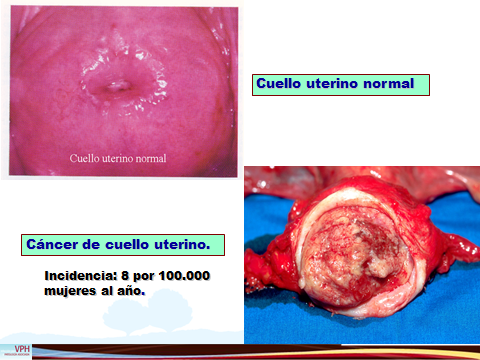 PREVENCION DEL CANCER DE CERVIX-1.jpg