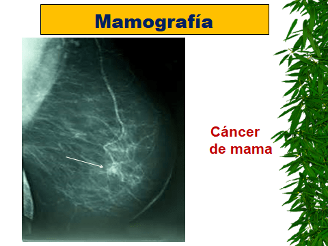 CANCER DE MAMA