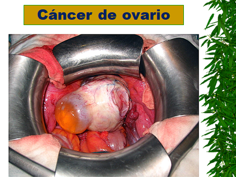 CANCER DE OVARIO
