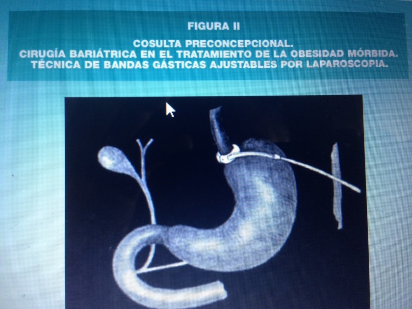 cirugia bariatrica
