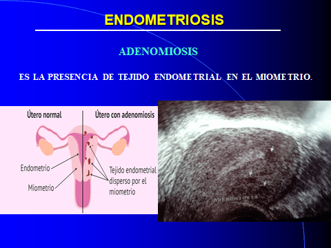 ADENOMIOSIS.DIAPOSITIVA