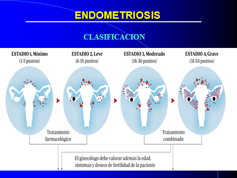 ENDOMETRIOSIS. CLASIFICACION.2
