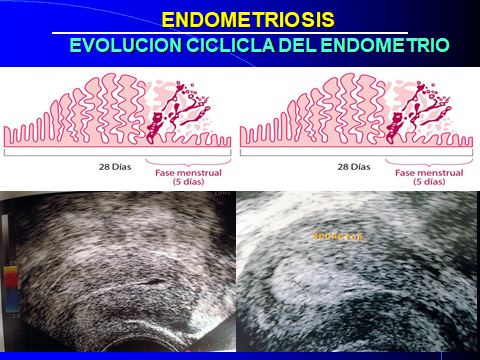 ENDOMETRIOSIS. EVOLUCION CICLICA