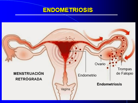 ENDOMETRIOSIS. MENSTRUACION RETROGRADA-1