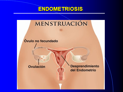 ENDOMETRIOSIS. MENSTRUACION