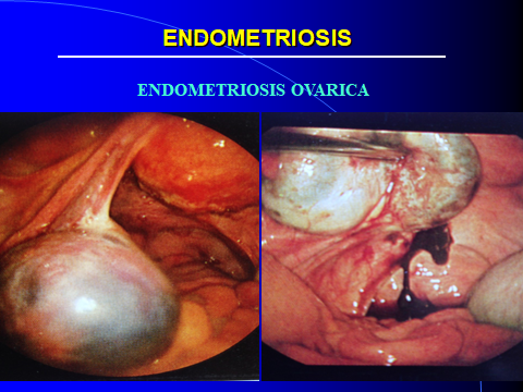 ENDOMETRIOSIS OVARICA-DIAPOSITIVApg.jpg