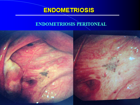 ENDOMETRIOSIS PERITONEAL-DIAPOSITIVA.jpg