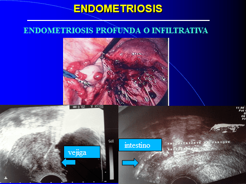 ENDOMETRIOSIS PROFUNDA DIAPOSITIVA-2.jpg