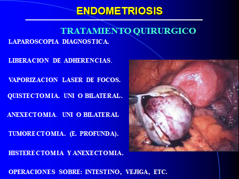 ENDOMETRIOSIS. TRATAMIENTO. QUIRURGICO