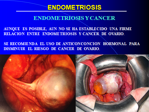ENDOMETRIOSIS Y CANCER