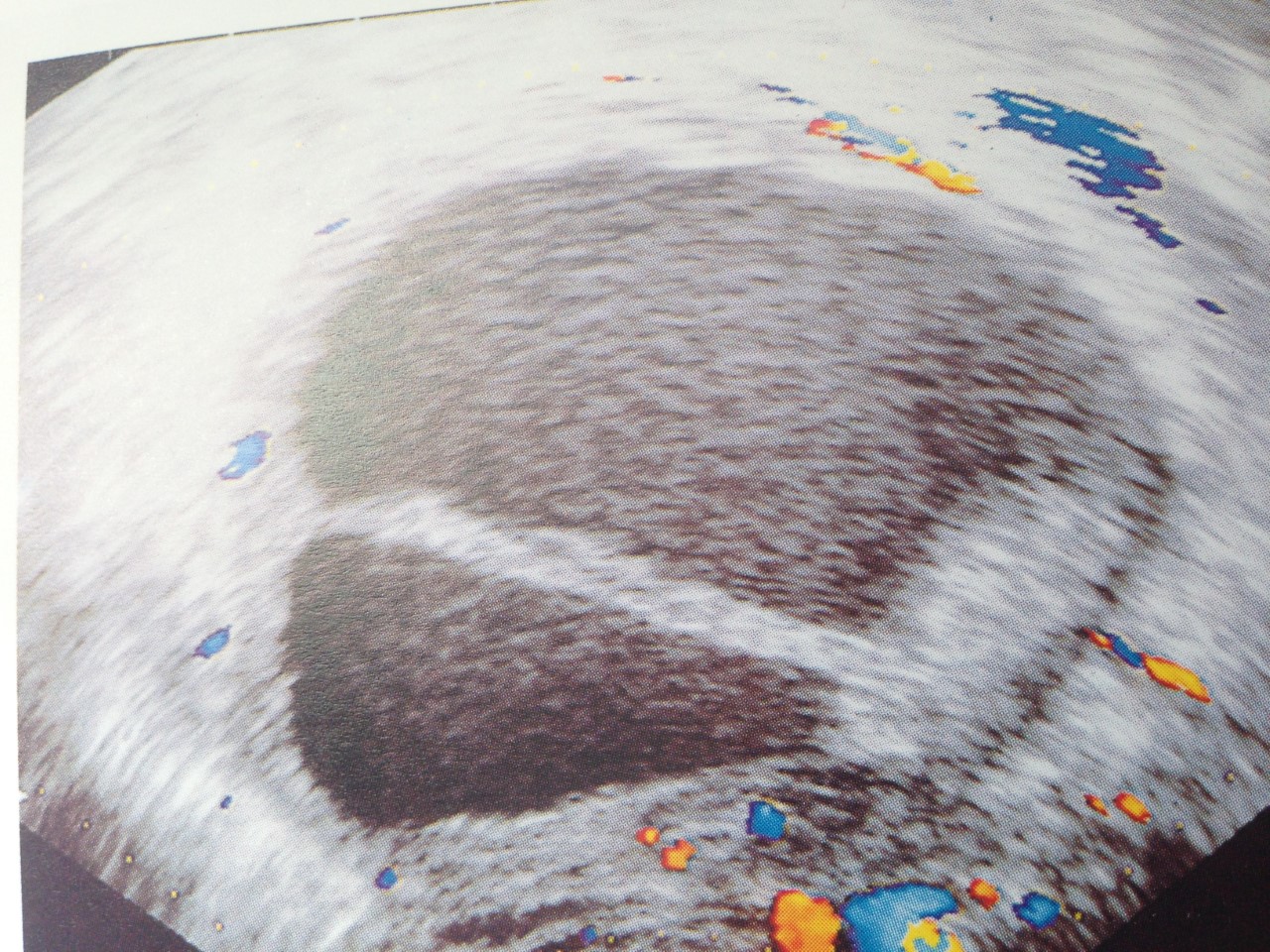 ENDOMETRIOMA BILOBULADO