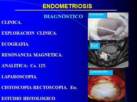 ENDOMETRIOSIS. DIAGNOSTICO-1.