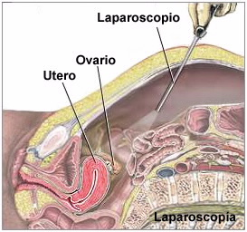 ENDOMETRIOSIS. lAPAROSOCOPIA