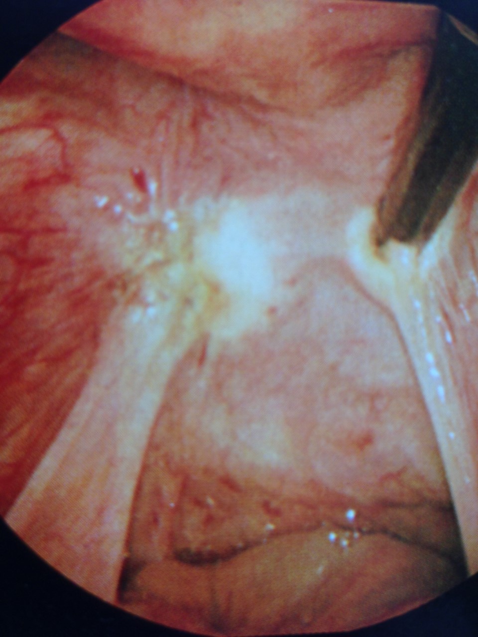 ENDOMETRIOSIS PERITONEAL-2jpg