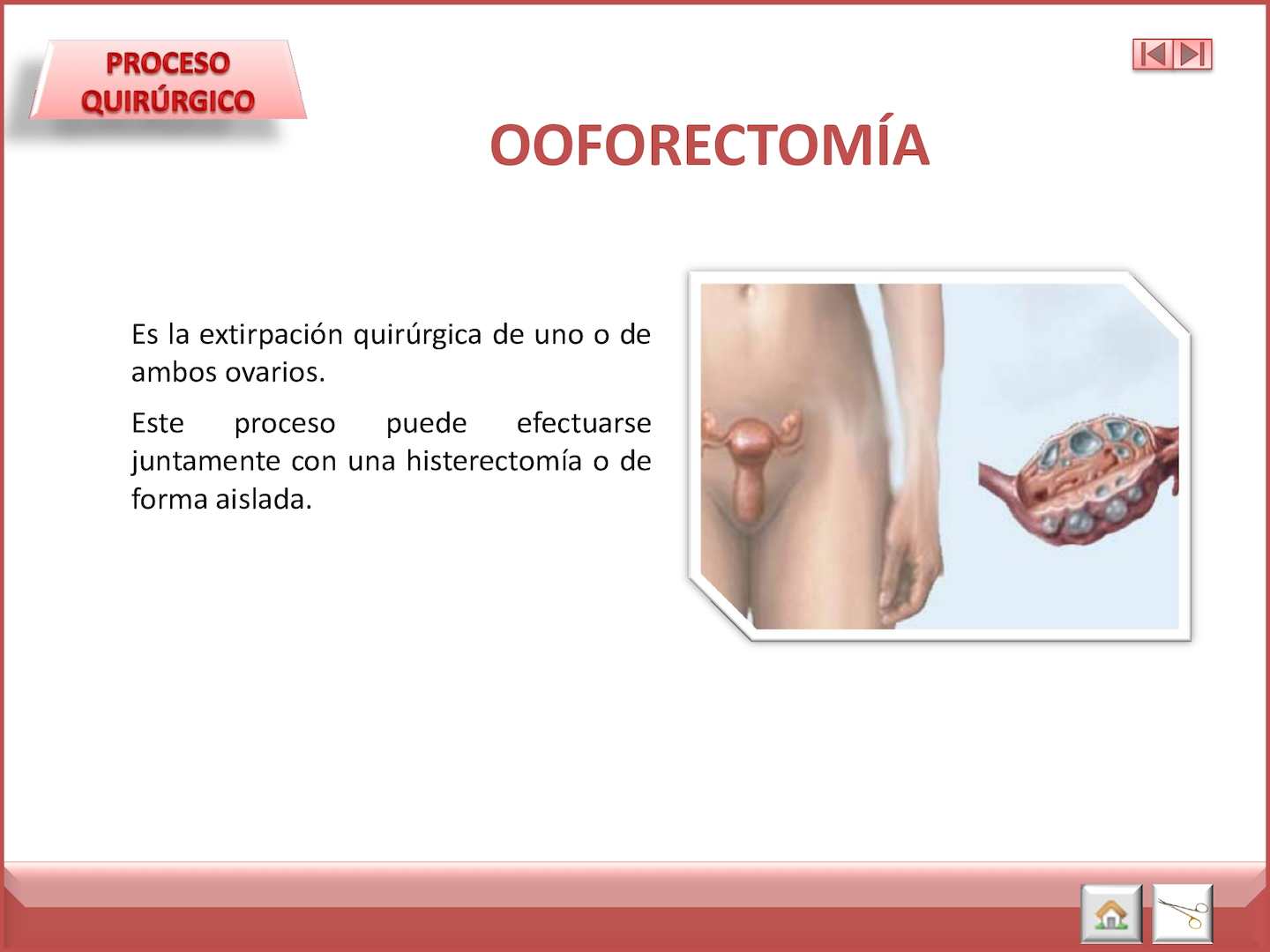 OOFORECTOMIA.jpg