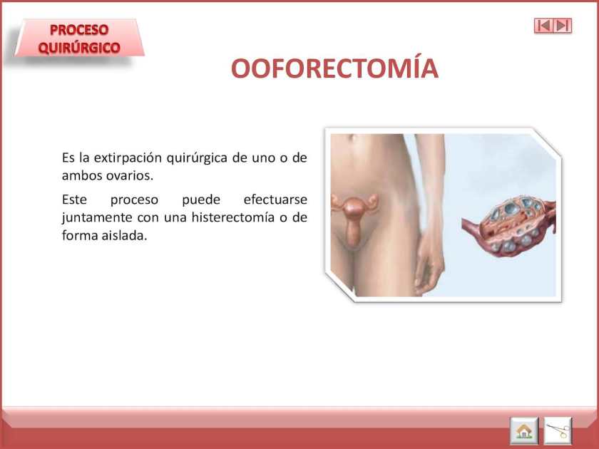 OOFORECTOMIA.jpg